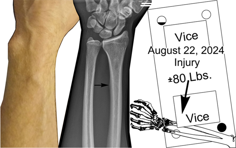Radius Bone Abnormality At Injury Location